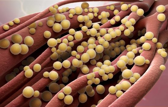 Septicemia – ce este și cum și dacă se tratează