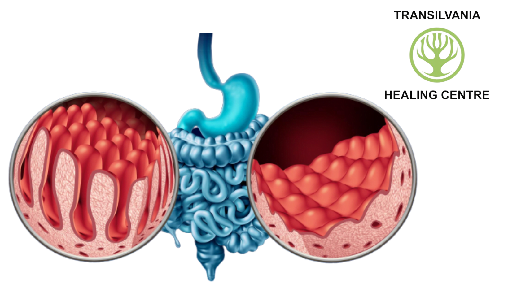 gluten Descopera tot ce trebuie sa stii despre boala celiaca, inclusiv cauzele, simptomele si optiunile de tratament.