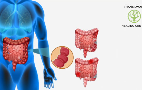 Remediază Vizualizați soluții pentru colonul iritabil - Imagini și ilustrații relevante