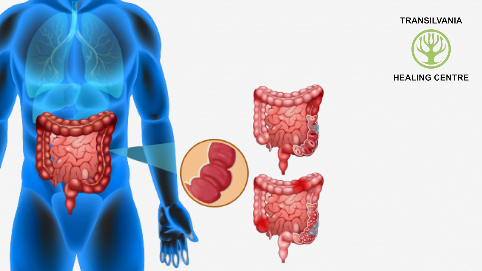 Remediază Vizualizați soluții pentru colonul iritabil - Imagini și ilustrații relevante