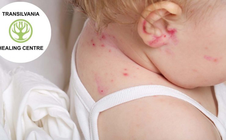 atopica Combaterea Dermatitei Atopice la Micuții Noștri - Sfaturi și Tratamente Eficiente