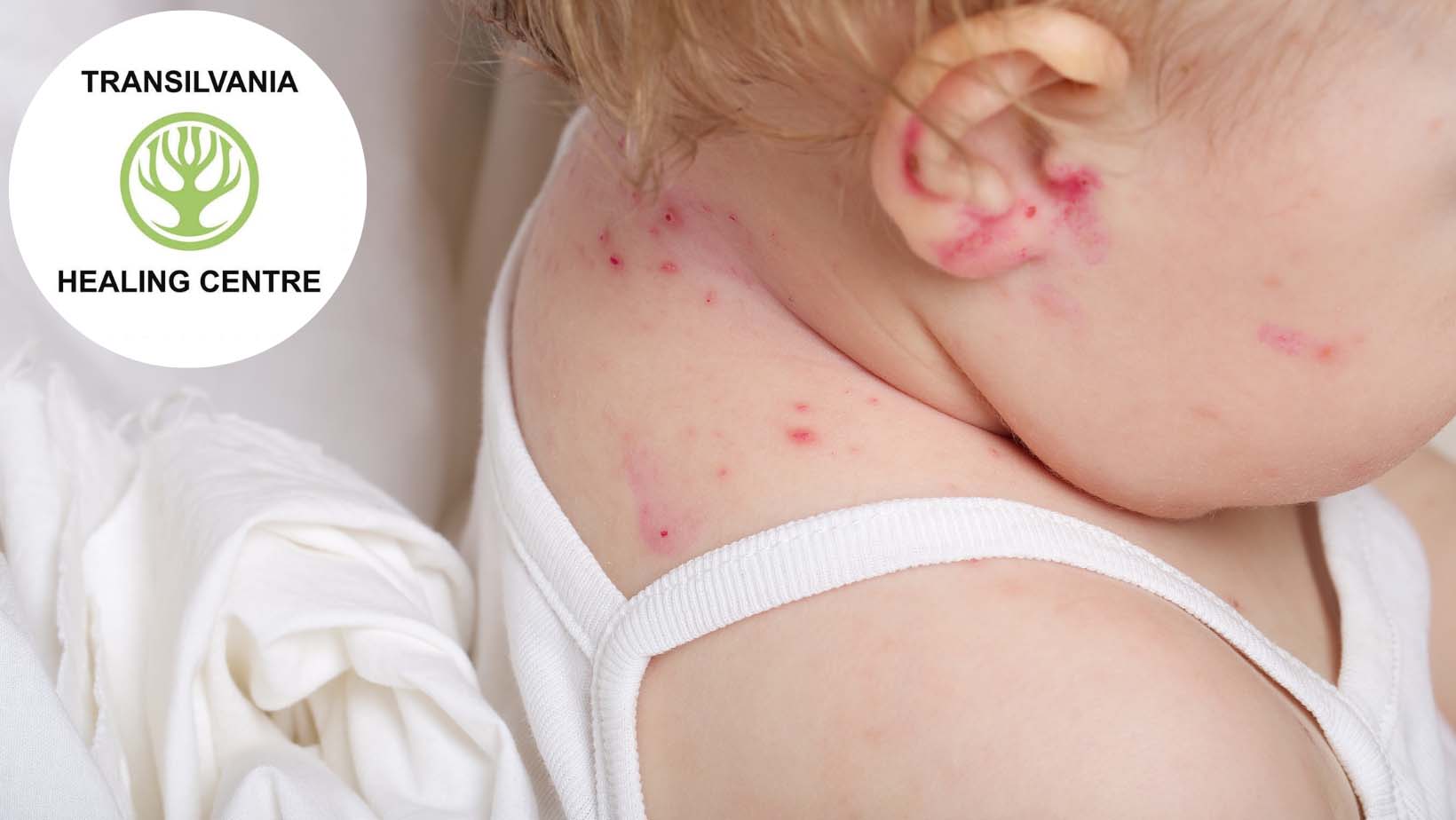 atopica Combaterea Dermatitei Atopice la Micuții Noștri - Sfaturi și Tratamente Eficiente